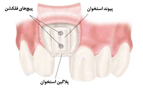 پیوند بلوک استخوان