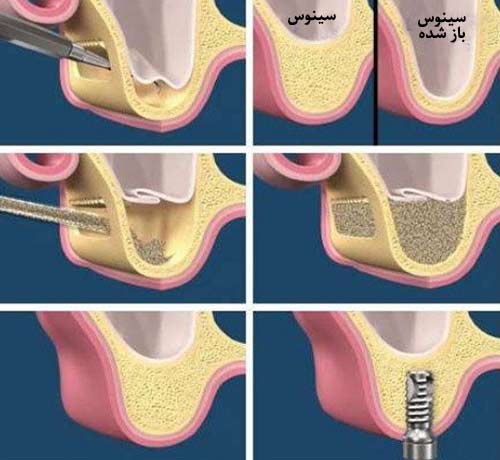 پیوند استخوان لیفت سینوس