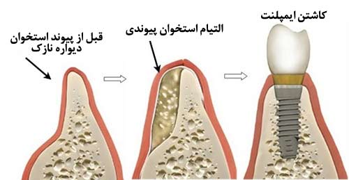 پیوند استخوان